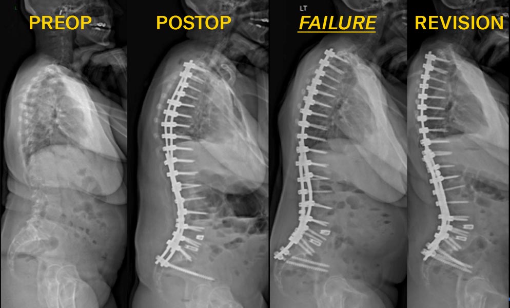 Radiology images of a female with adult idiopathic scoliosis who underwent posterior spinal instrumented fusion