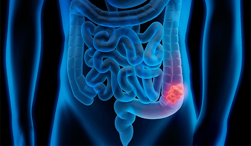 illustration of colon cancer