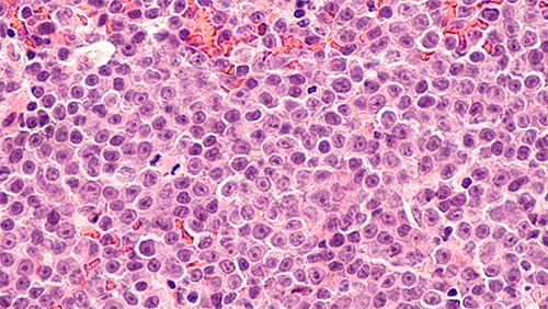 image of micrograph of diffuse large B-cell lymphoma