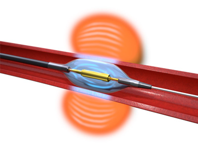 image of the Paradise Renal Denervation System