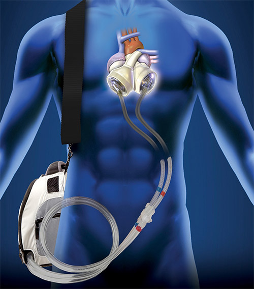 vector illustration of the total artificial heart in a human body (photo courtesy of SynCardia)
