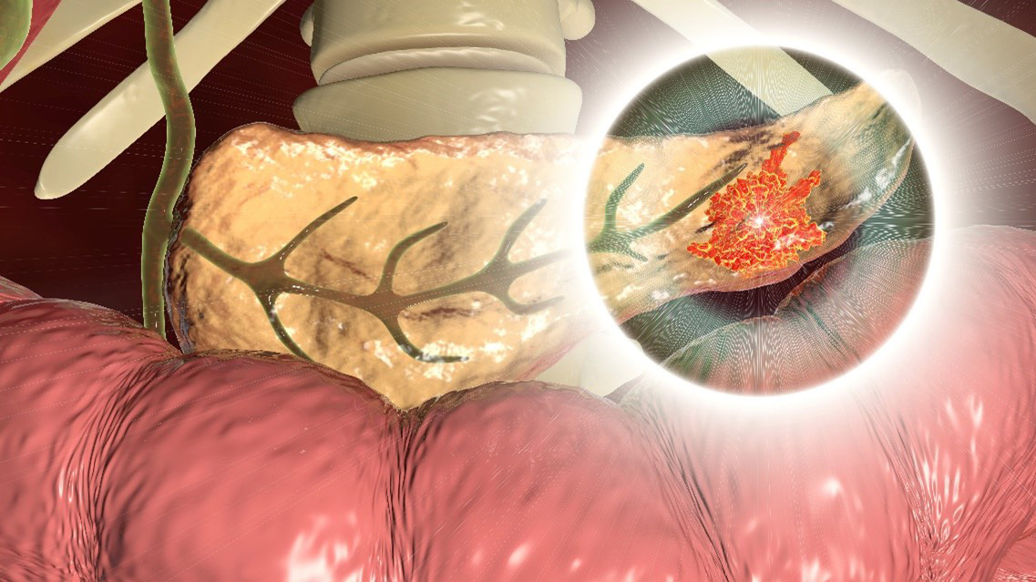 Malignant tumor in the pancreas