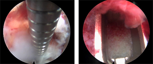 image of doing surgery through endoscope