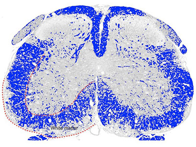 image of spinal cord section from an MS model reveals extensive myelin damage (blue) in the white matter tracts