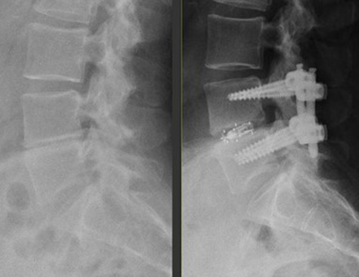 image of Preoperative and postoperative X-rays