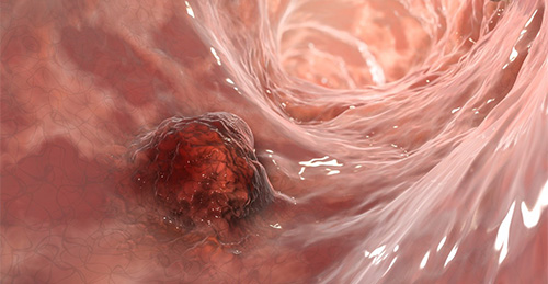 digital illustration of colorectal cancer
