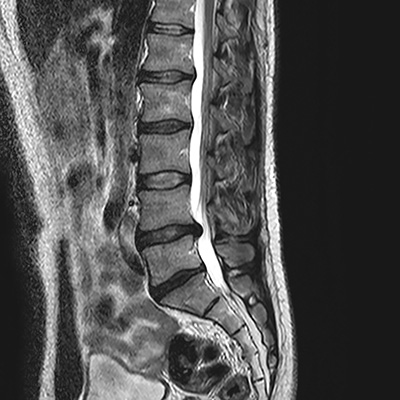 MRI of herniated spinal disc