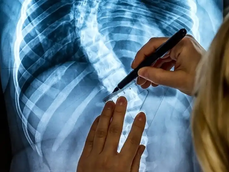 Can Minimally Invasive Surgery Treat Scoliosis?