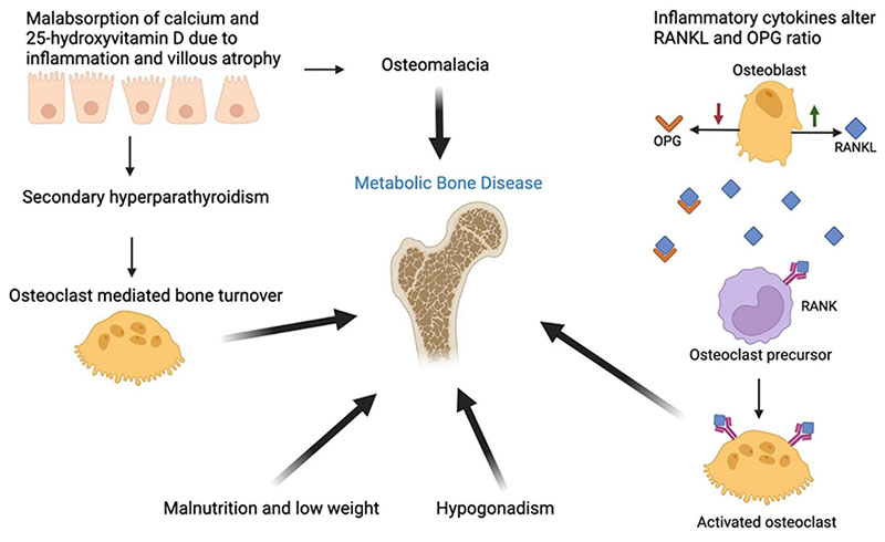 image of metabolic bone disease schematic