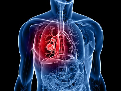 lung cancer stock image