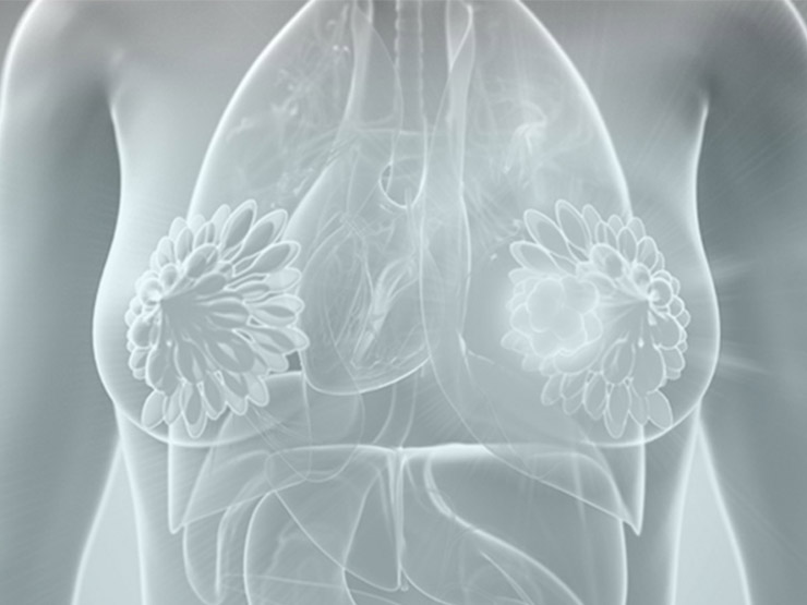 6 Common Breast Cancer Myths Debunked