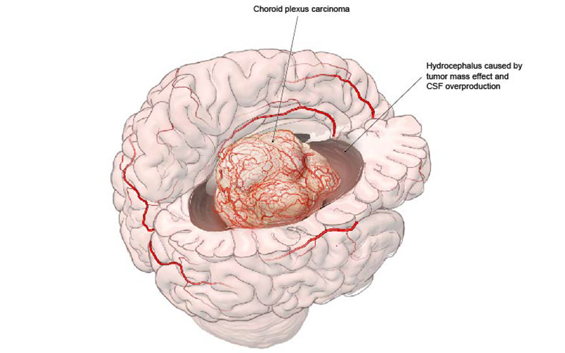 digital illustration of choroid plexus carcinoma with symptoms of hydrocephalus