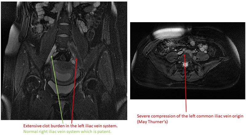 Extensive clot burden in the left iliac vein system and severe compression of the left common vein origin