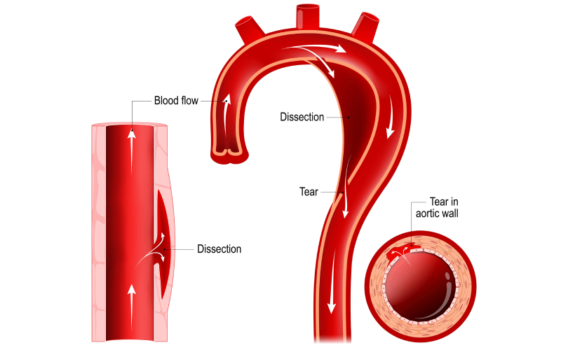 Diagram of an aortic dissection