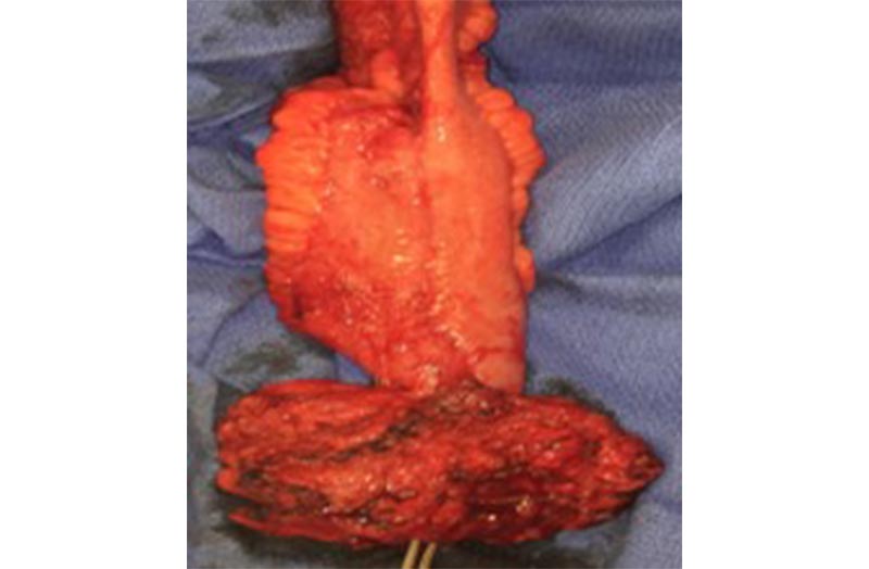 Intraoperative photo of a redo J pouch for retained rectum