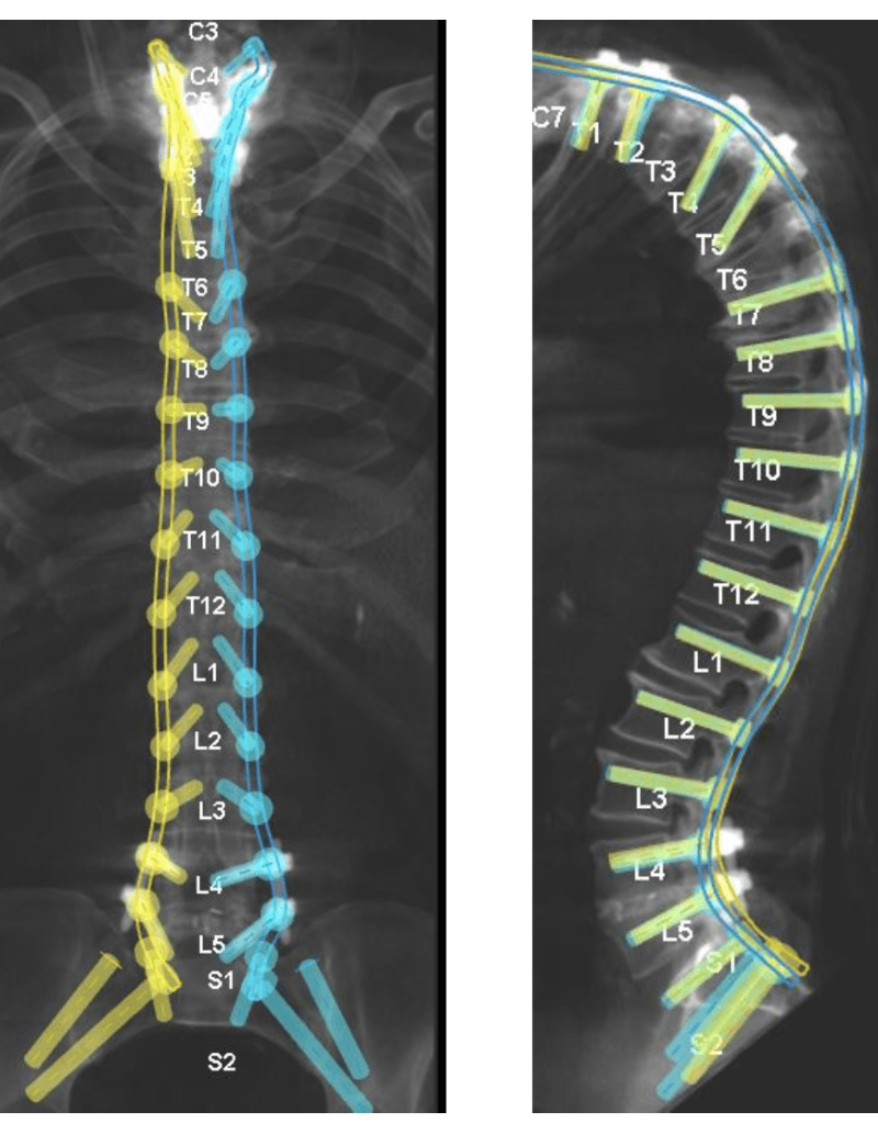  Screw and instrumentation plan of patient's spine