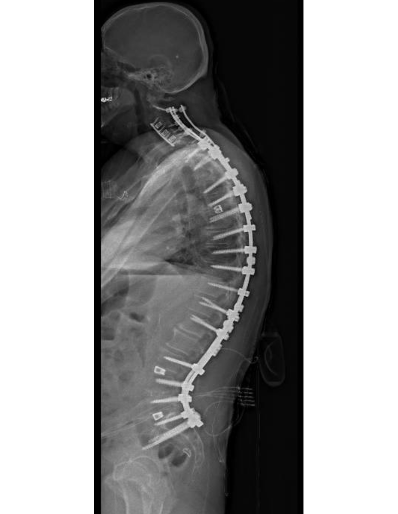 Post op x-ray of patient's spine