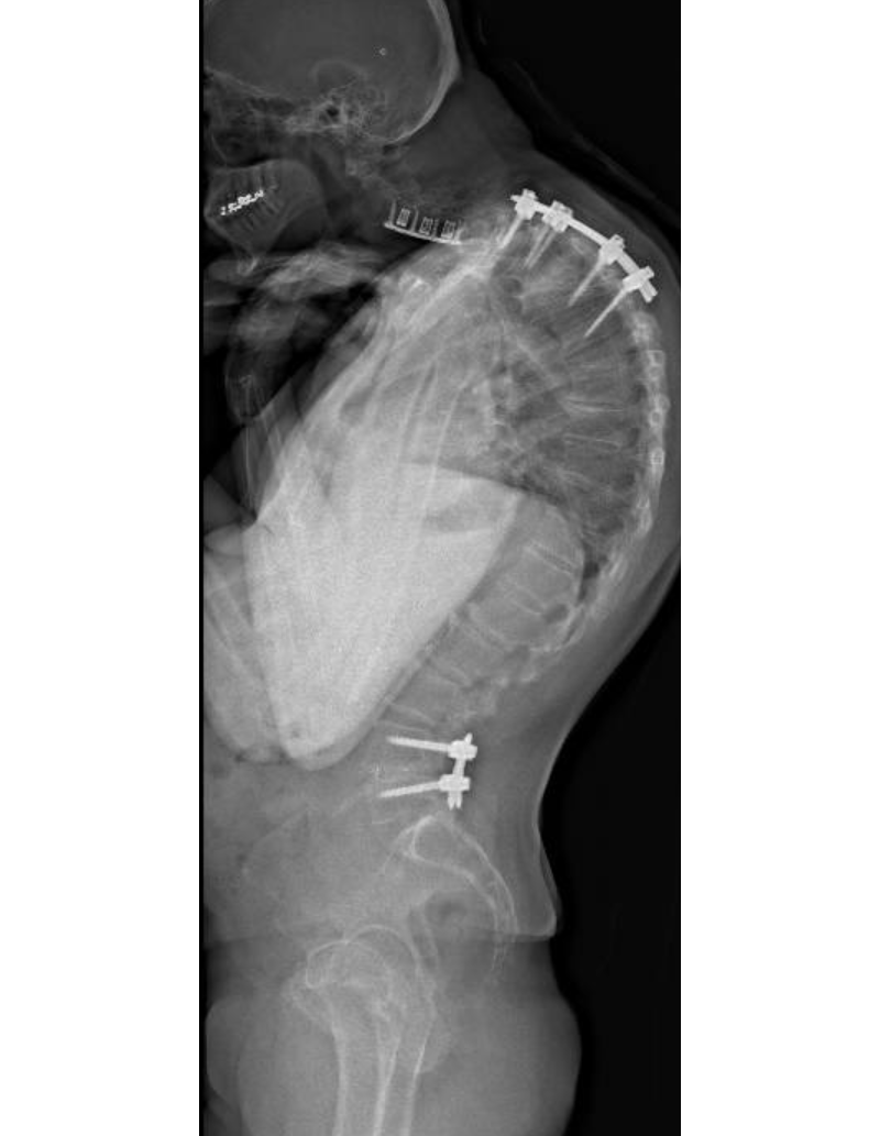 Preoperative x-ray of patient's spine