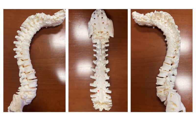 3D printed model of spine used to plan surgery