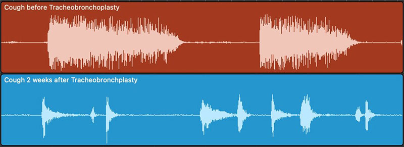 Visual waveform representation of this patient’s cough