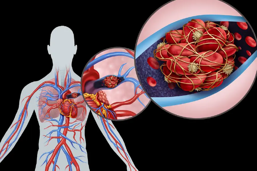 A surgical sample showing the clot and scar tissue removed from a patient with CTEPH during PTE