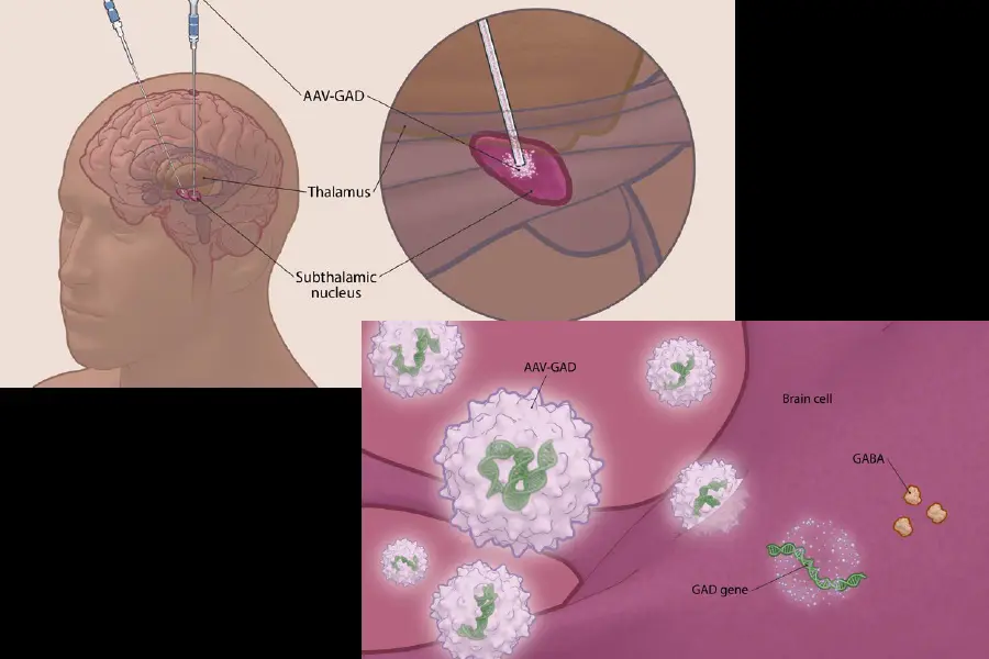 Top Left: AAV-GAD is delivered directly to the subthalamic nucleus via catheter infusion. Bottom Right:AAV-GAD is an investigational gene therapy designed to deliver the GAD gene to the STN to increase GABA production