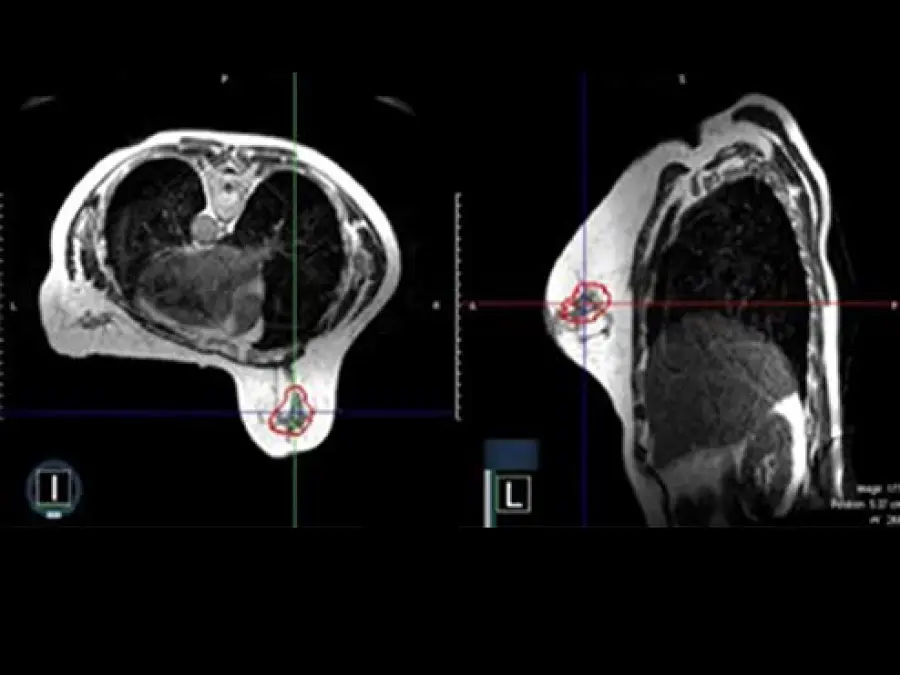 A representative surgical cavity target volume seen from an MRI image acquired on-table on the day of the radiation treatment. The MRI scans in both the axial and sagittal planes are shown. The surgical cavity is outlined in red.