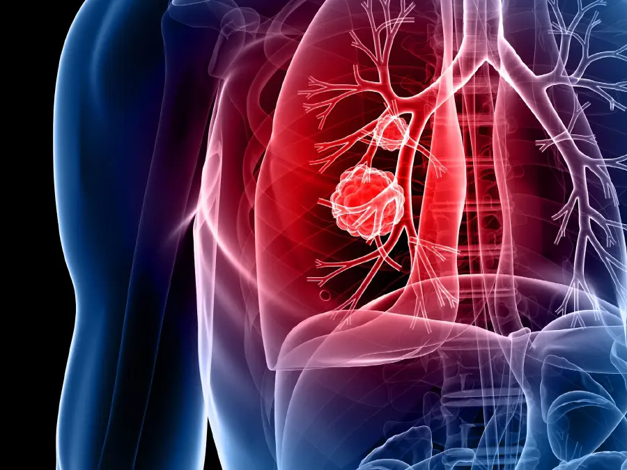 A Seminal Study Shows Promise for NSCLC Treatment