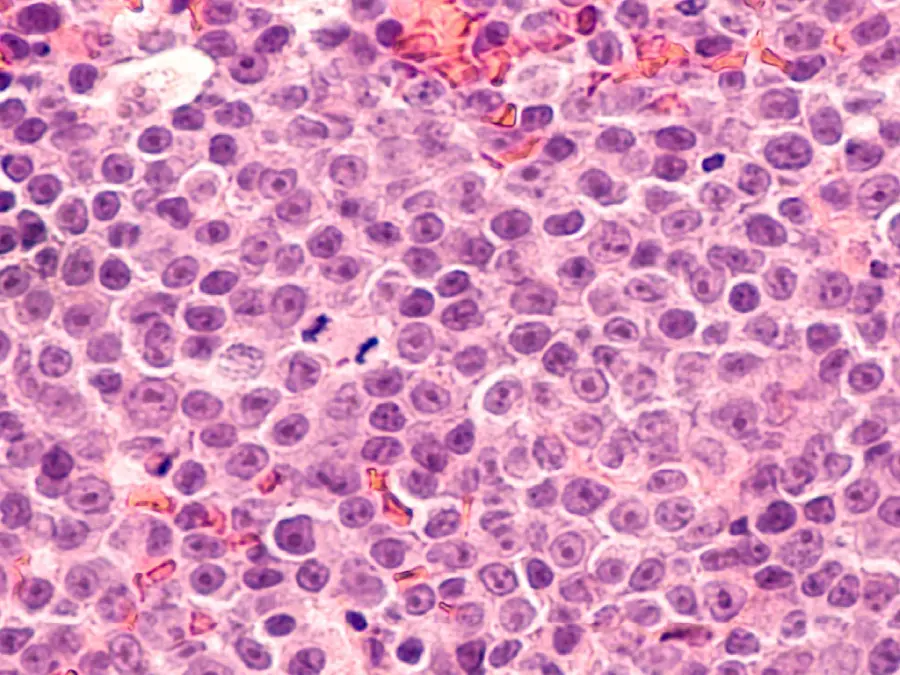 Micrograph of diffuse large B-cell lymphoma