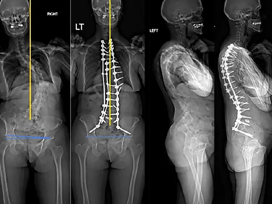 Preop and postop EOS films of patient who underwent adult spinal deformity surgery. Preop films show coronal malalignment with lower extremity compensation. Postop films demonstrate well-aligned spine in sagittal and coronal planes with resolution of lower extremity compensation