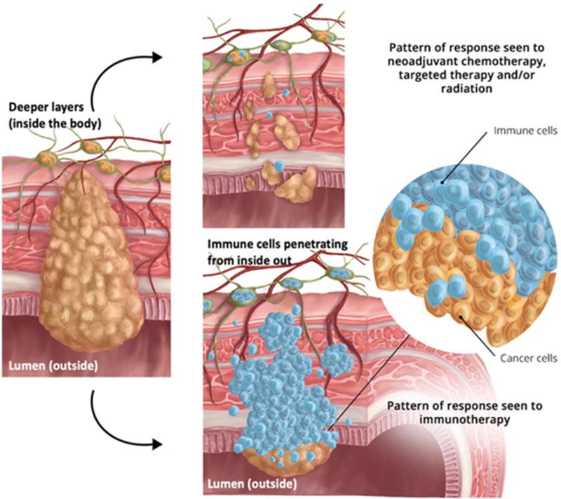 digital illustration of immunotherapy pattern of response