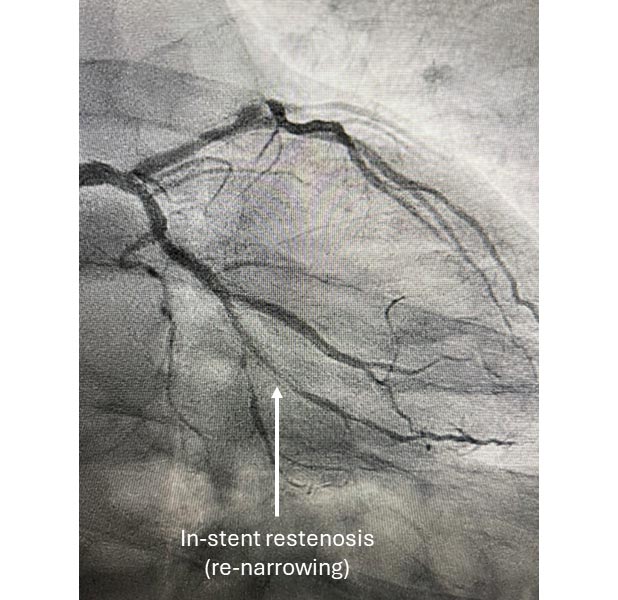 Angiogram showing coronary in-stent restenosis