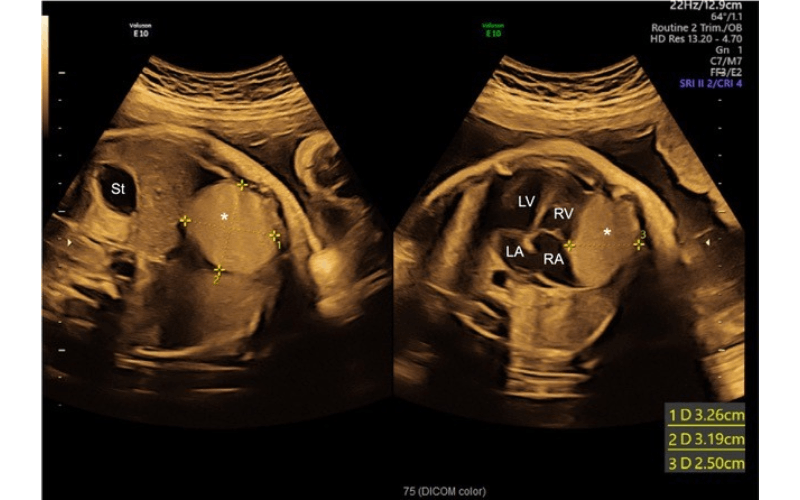 Ultrasound of fetal cardiac mass