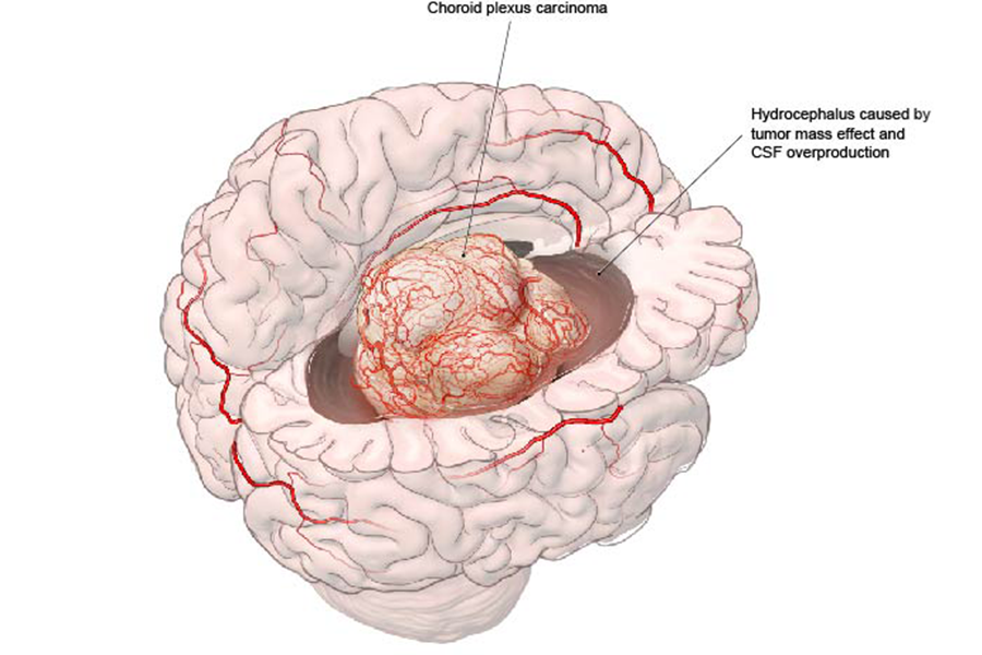 Example of a choroid plexus carcinoma presenting with symptoms of hydrocephalus