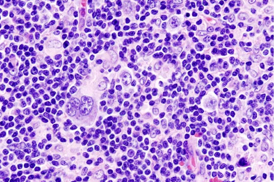 Hodgkin lymphoma biopsy demonstrating rare Hodgkin and Reed-Sternberg cells in a dense immune infiltrate.
