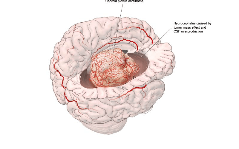 Choroid plexus carcinoma