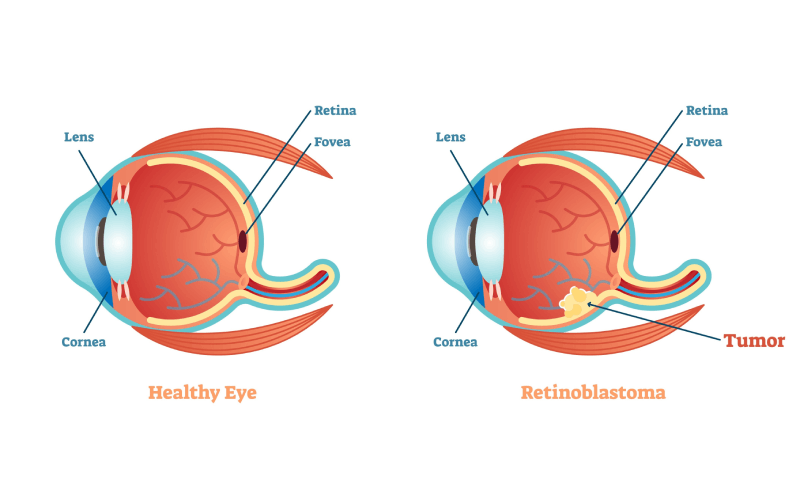 Retinoblastoma vs. healthy retina