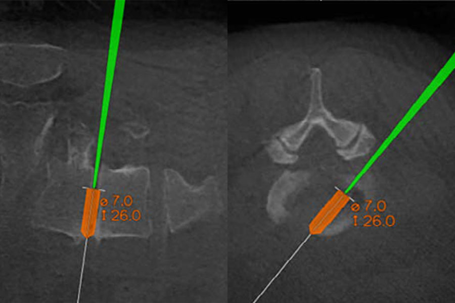 3D-navigation-guided trajectory mapping for the planning and sizing of an implant.