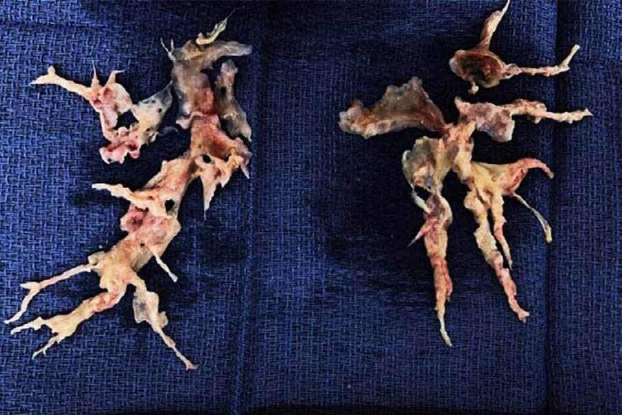 A surgical sample showing the clot and scar tissue removed from a patient with CTEPH during PTE