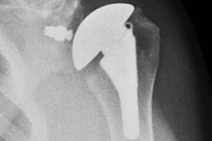 Left: Pre-operative image of shoulder before total shoulder arthroplasty. Right: Post-operative image showing the new prosthesis in place.