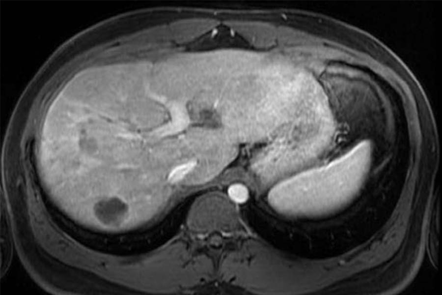 3D-navigation-guided trajectory mapping for the planning and sizing of an implant