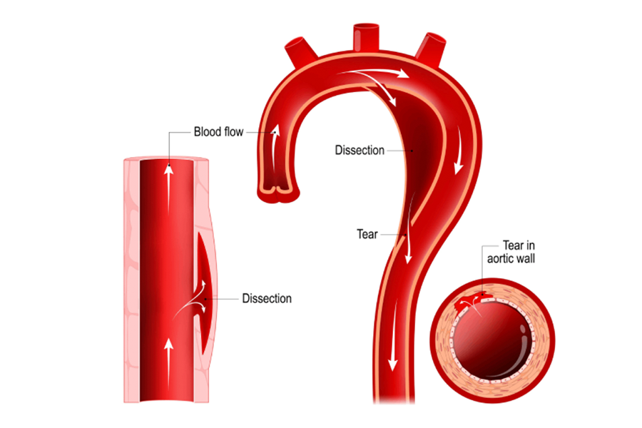 Individuals with Marfan syndrome are at an increased risk of an aortic dissection.