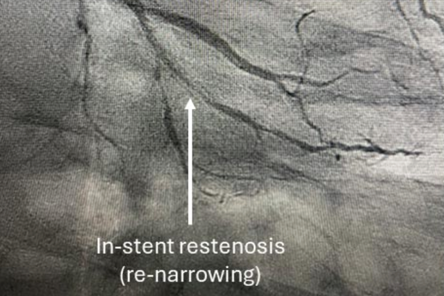 Angiogram showing coronary in-stent restenosis