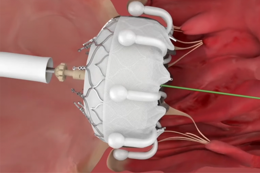 This transcatheter therapy system is to be delivered via the femoral artery without any incisions.