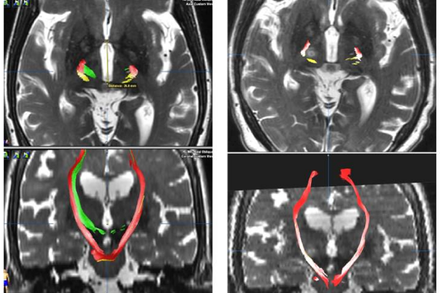 Axial and coronal images from (L) before bilateral treatment and (R) after the procedure. The green is the target of the MRgFUS ablation whereas the red and yellow portions are nearby structures. After treatment, the nearby structures remain untouched, showing that the brain was successfully ablated bilaterally without affecting nearby structures.