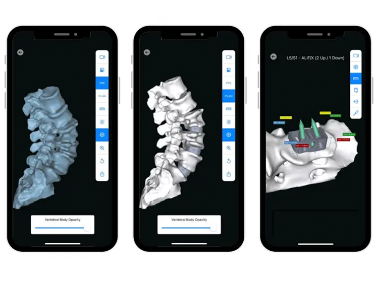 The AI-enabled planning software generates personalized alignment plans and patient-specific device designs that are reviewed, refined, and approved by each surgeon through a mobile 3D visualization platform. Photo credit: Carlsmed, Inc.