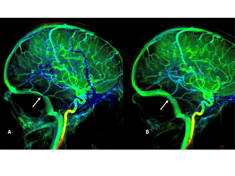 Srikanth Reddy Boddu, MD, an interventional neuroradiologist at NewYork‑Presbyterian and Weill Cornell Medicine and director of interventional neuroradiology at NewYork‑Presbyterian Queens, is one of a few physicians in the country who treats idiopathic intracranial hypertension (IIH) with minimally invasive techniques. Recent research on IIH outlined challenges with the standard of care, pharmacologic treatment, which often comes with side effects, or a ventriculoperitoneal (VP) shunt. Nearly half of VP shunts fail after two years, necessitating additional procedures. Dr. Boddu and his team have innovated a third option for patients: venous sinus stenting. This option is the most effective treatment for IIH according to meta-analyses, offering immediate relief from pulsatile tinnitus and potentially resolving vision issues within three months.