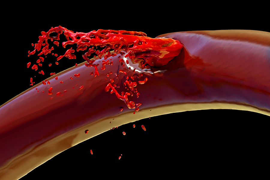 Understanding Intracerebral Hemorrhage in Pregnancy