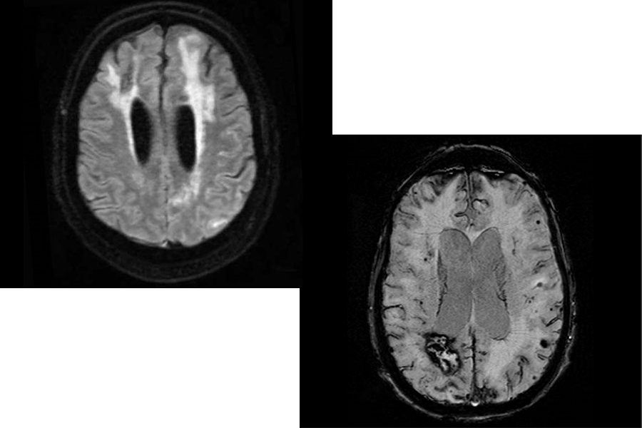 Left: Image from a fluid-attenuated inversion recovery (FLAIR) sequence from an MRI showing the imaging signature of CAA-ri: asymmetric cortical and subcortical hyperintensities suggestive of vasogenic edema and sulcal effusion. Right: Susceptibility-weighted imaging sequence of an MRI showing multiple imaging hallmarks of CAA: lobar intracerebral hemorrhage, multiple lobar microhemorrhages, and cortical superficial siderosis.