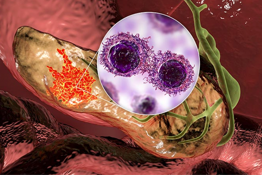 The Chemo4METPANC trial explores the combination of chemotherapy, immunotherapy, and a CXCR4 inhibitor to improve progression-free survival for metastatic pancreas cancer.